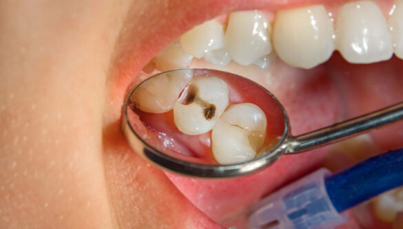 Trattamento ortodontico e carie: i risultati di una ricerca sugli adolescenti