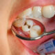 Trattamento ortodontico e carie: i risultati di una ricerca sugli adolescenti