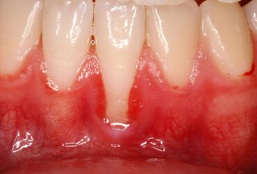 centro-odontostomatologico-coppola-dentista-gallarate-dentista-varese-terapia-parodontologia-maffei-pre