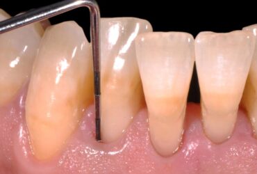 sondaggio-parodontale-1-studio-amosso-dentista-biella-3600x2400