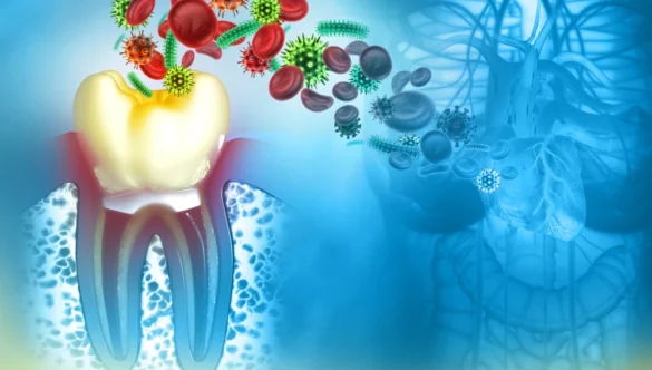 Microbiota orale, alitosi e parodontite